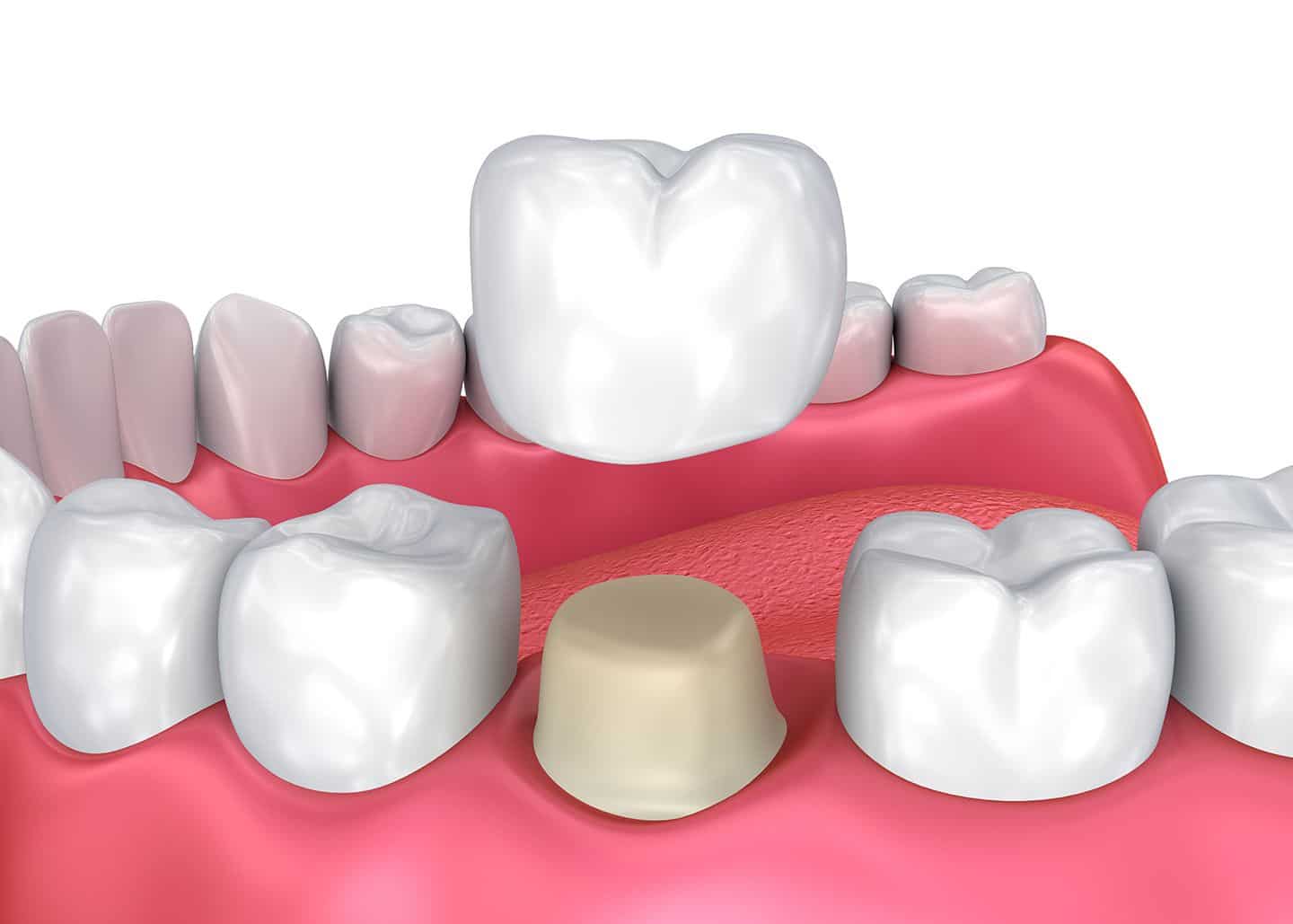 ما هو تاج الاسنان؟ ما هي اهم (4) استخدامات لتاج الاسنان؟