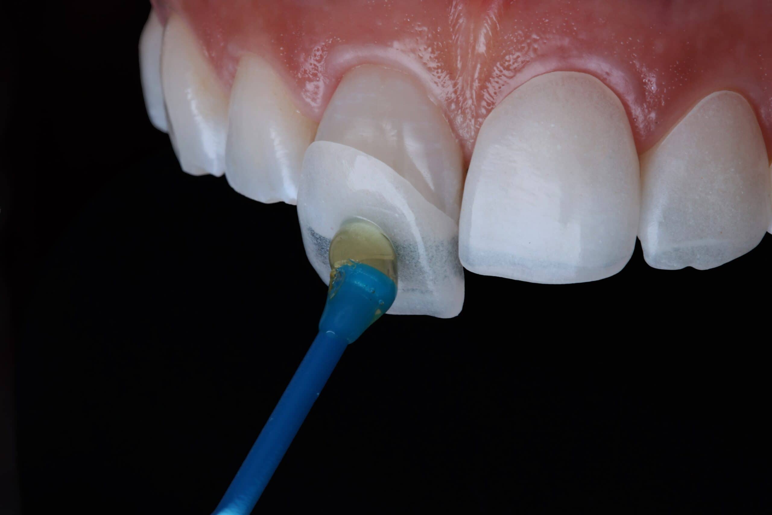 كيفية إزالة عدسات الأسنان