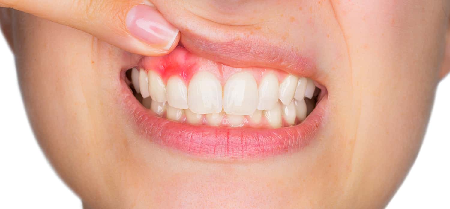 التهاب-اللثة-بعد-زراعة-الاسنان