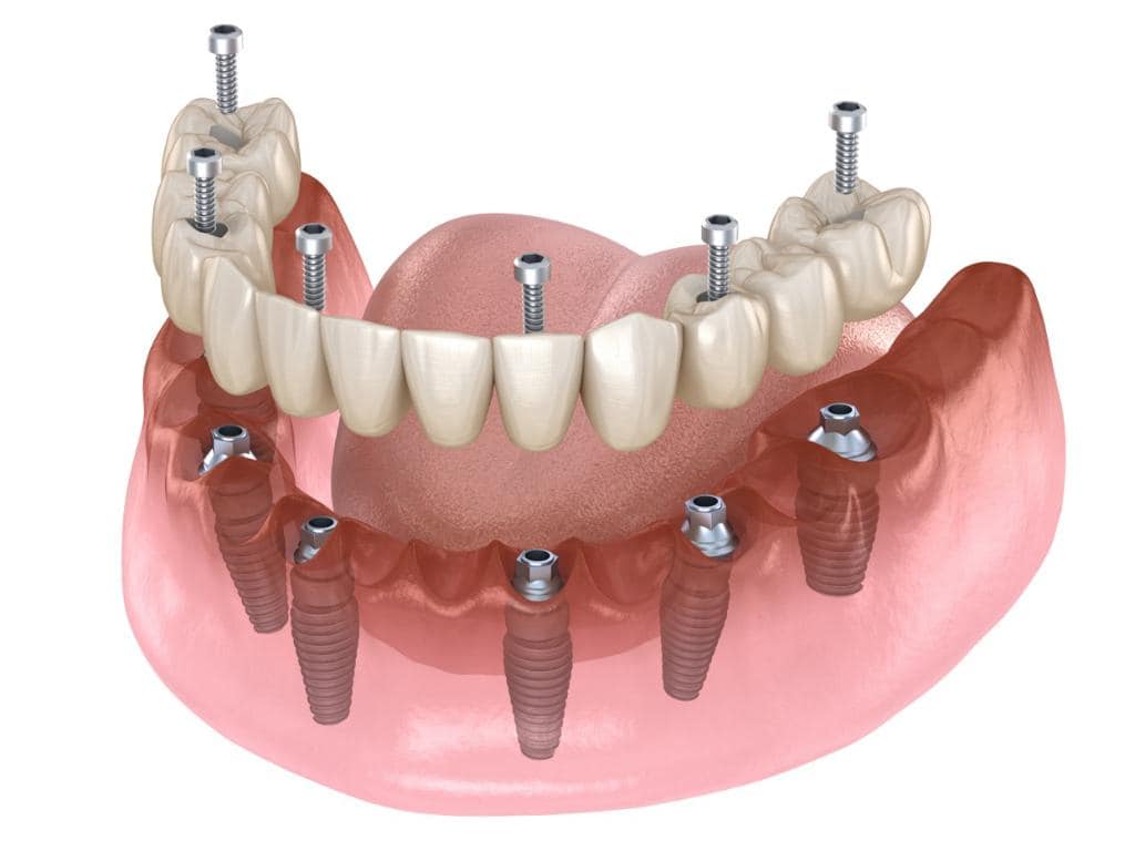 تقنية all-on-X -لزراعة-الاسنان