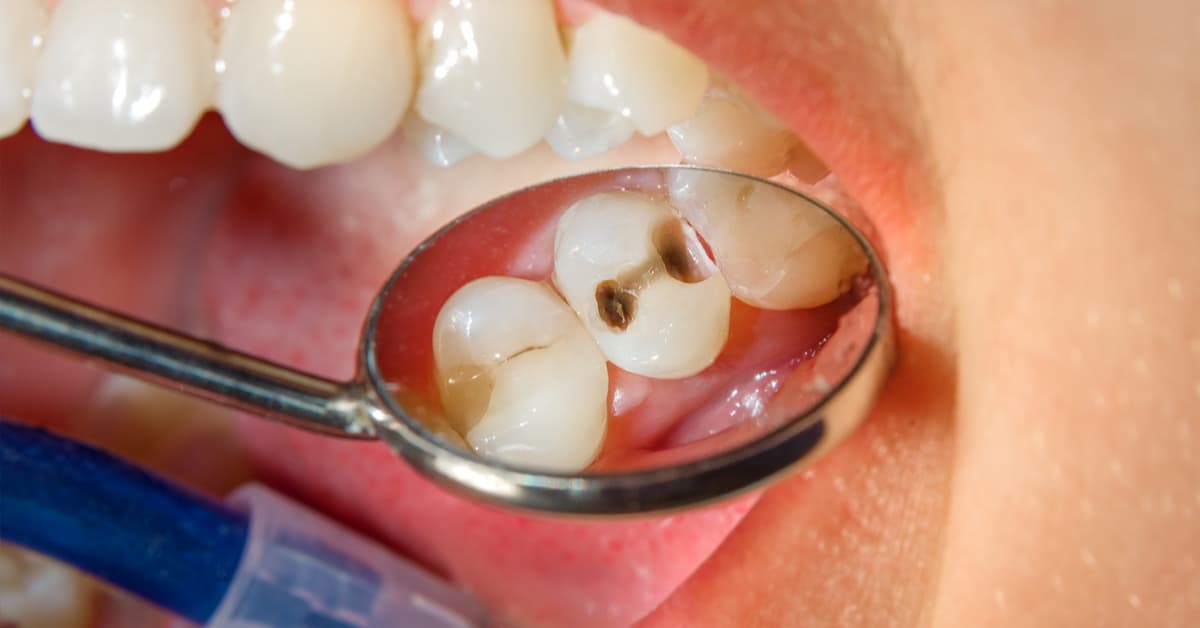 علامات تسوس الأسنان