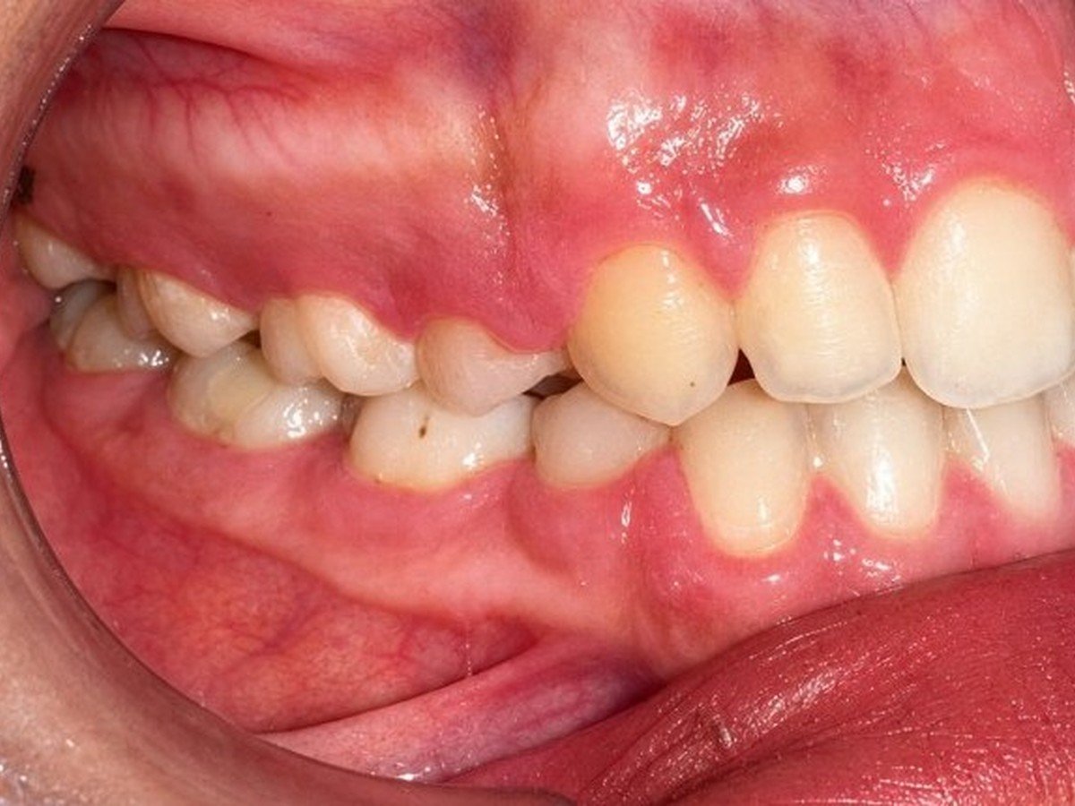 قبل العلاج — منظر جانبي أيمن