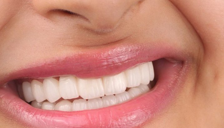 نتيجة جمالية نهائية بعد خطة الزيركون وتشكيل اللثة